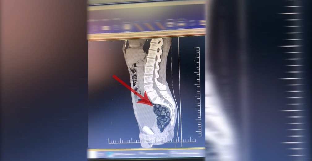 Otobus Yolcusunun Midesinden Metamfetamin Cikti-1
