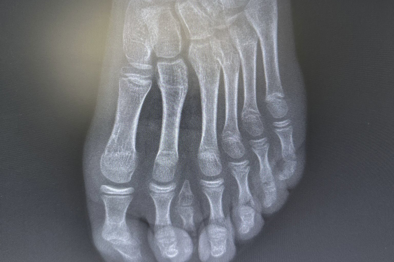 Batmanda Polidaktili Vakası 7 Parmaklı Ayak Mikrocerrahi Tedavi Edildi 1