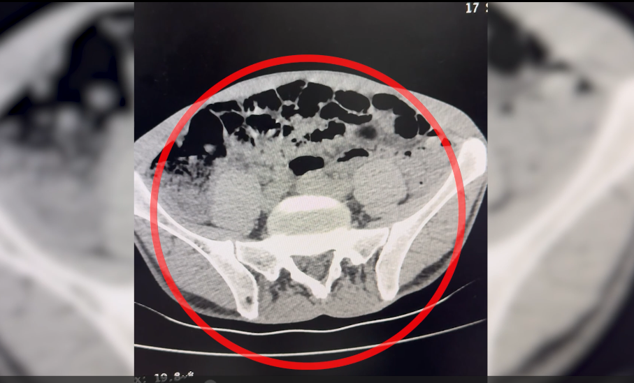 Batman’da Otobüste Yakalandı Sindirim Sisteminden 35 Parça Eroin Çıktı-1
