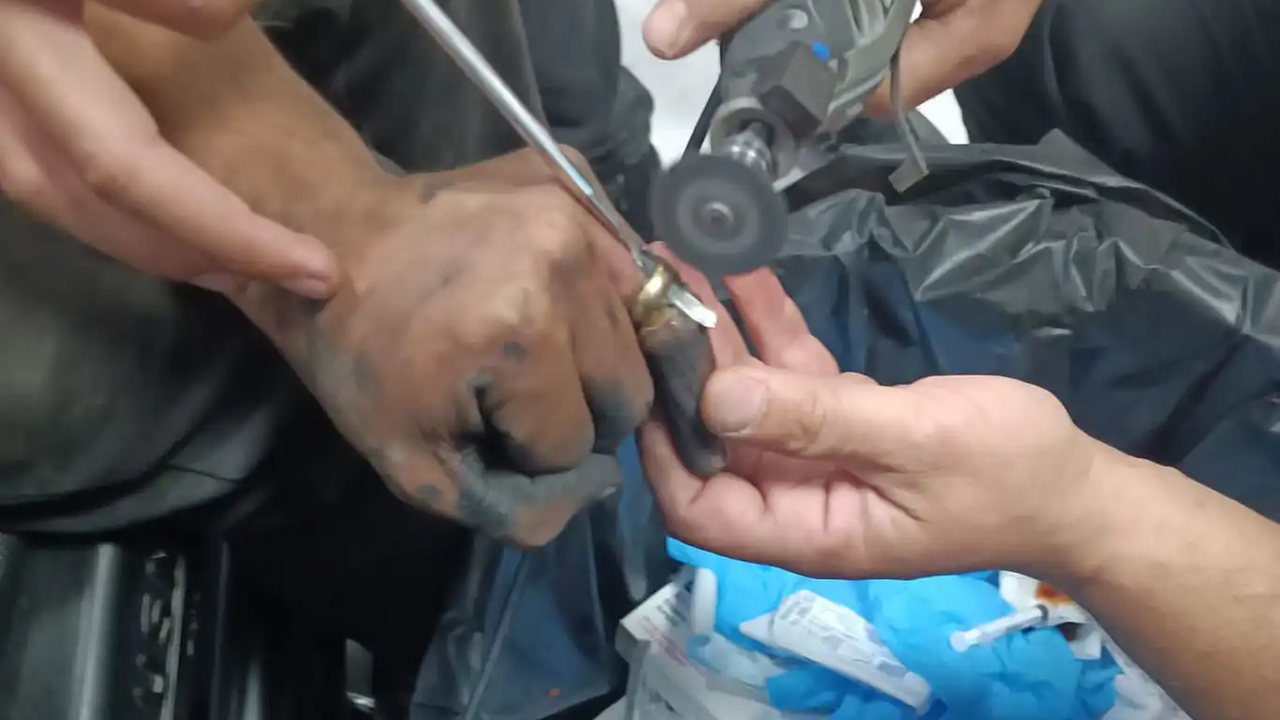 Batman'da parmakta sıkışan yüzük operasyonuyla çıkarıldı