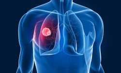 Kısa süreli kontroller akciğer kanserini erken teşhis ettiriyor