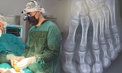 Batman’da Polidaktili Vakası: 7 Parmaklı Ayak mikrocerrahi tedavi edildi