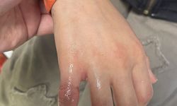 Parmağına Sıkışan Metal Parça Ekiplerce Çıkarıldı