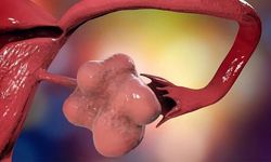 Pcos Neden Olur?
