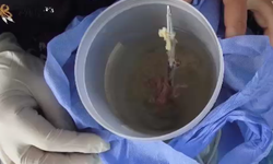 Ameliyatta karnında unutulan makas, 7 yıl sonra baş ağrısıyla ortaya çıktı