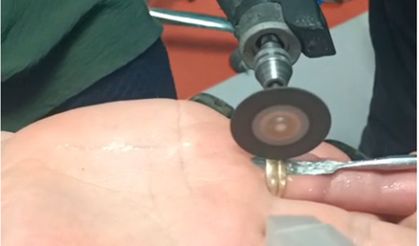 Yüzük Parmağını Kıskaca Aldı!