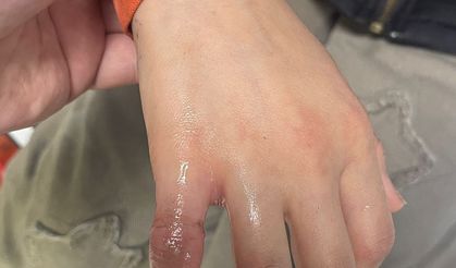 Parmağına Sıkışan Metal Parça Ekiplerce Çıkarıldı