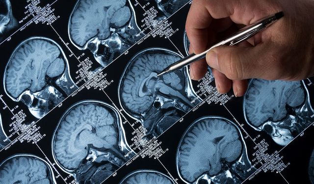 Alzheimer tedavisinde 'lityum' umudu