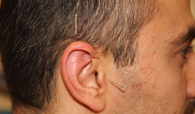 Batman'da akupunkturla binlerce hasta şifa buldu