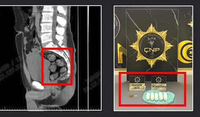İran'dan midesinde getirdiği 173,15 gram metamfetamin ile yakalandı