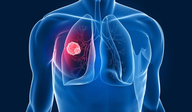Kısa süreli kontroller akciğer kanserini erken teşhis ettiriyor
