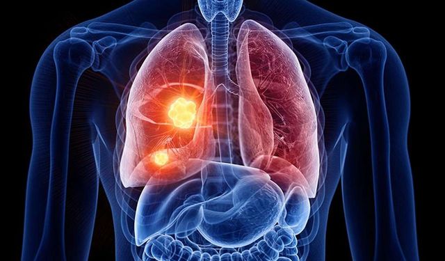 Akciğer kanseri riskini artıran faktörler