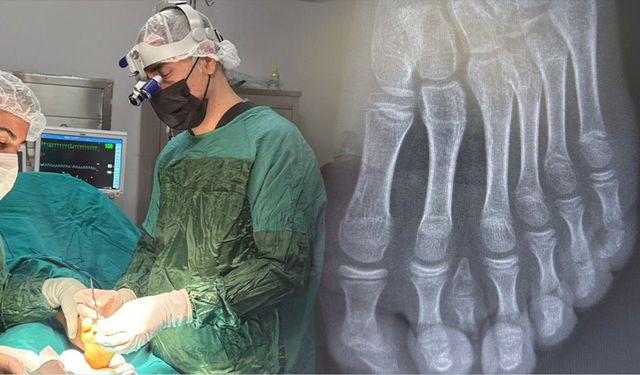 Batman’da Polidaktili Vakası: 7 Parmaklı Ayak mikrocerrahi tedavi edildi