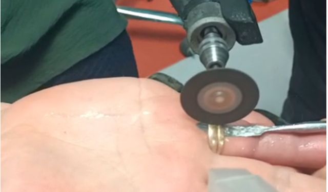 Yüzük Parmağını Kıskaca Aldı!