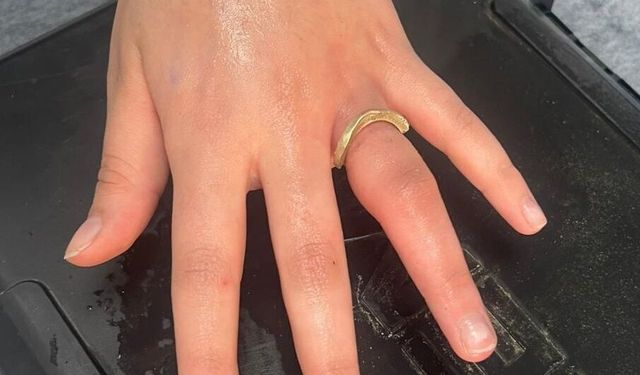 İtfaiye Parmakta Sıkışan Yüzüğü Çıkardı