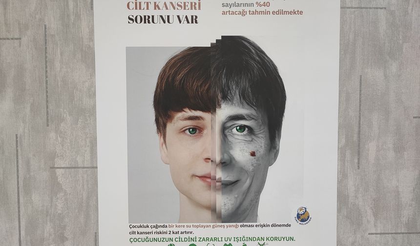 Cilt kanserinde erken tanı hayati önem taşıyor