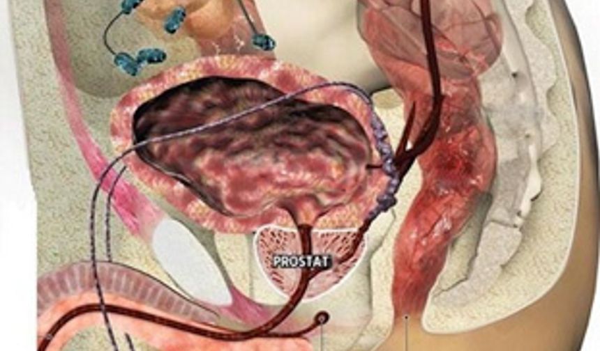 Prostat kanserinde umut veren sonuç: PSA testi uzun vadede etkili