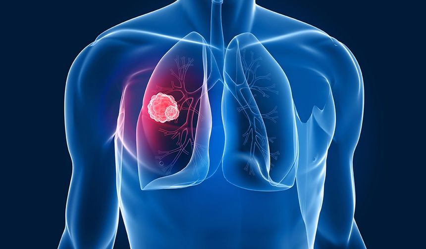Kısa süreli kontroller akciğer kanserini erken teşhis ettiriyor