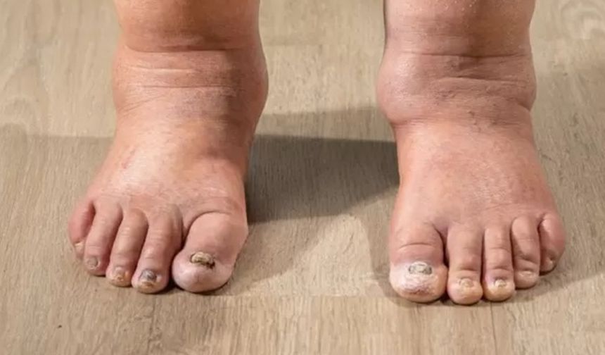 Kollarınızda veya bacaklarınızda şişlik varsa nedeni lenfödem olabilir!