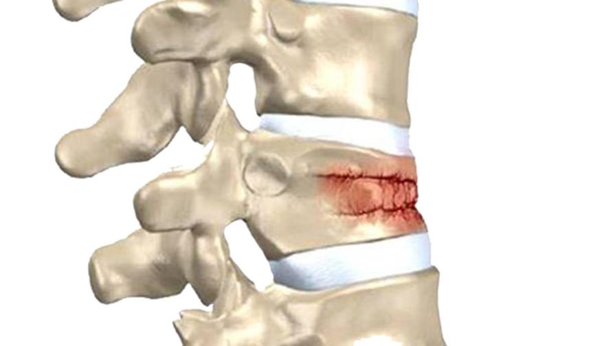 Omurga kırıkları kış aylarında artıyor