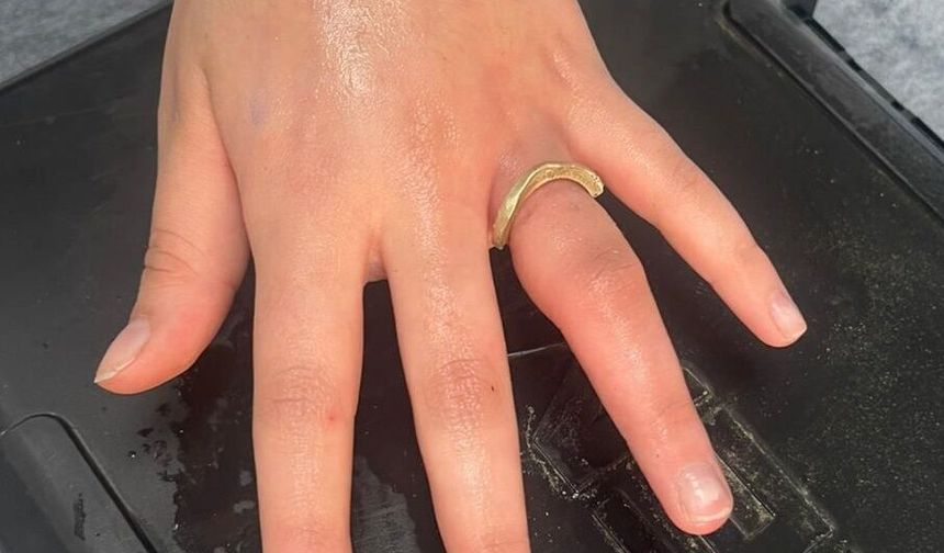 İtfaiye Parmakta Sıkışan Yüzüğü Çıkardı