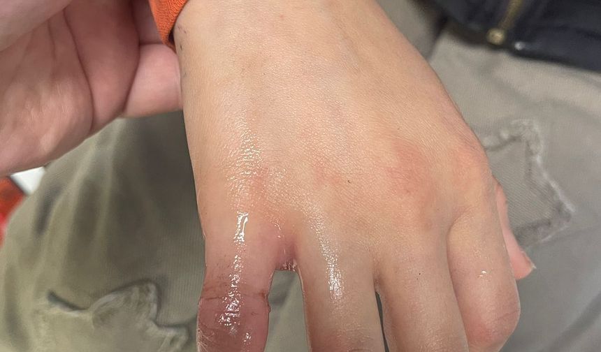 Parmağına Sıkışan Metal Parça Ekiplerce Çıkarıldı